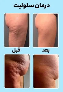 درمان سلولیت قبل و بعد