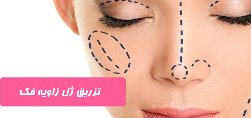 تزریق ژل زاویه فک