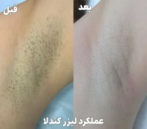 عملکرد لیزر کندلا