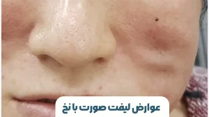 عوارض لیفت صورت با نخ