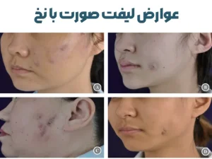 عوارض لیفت صورت با نخ