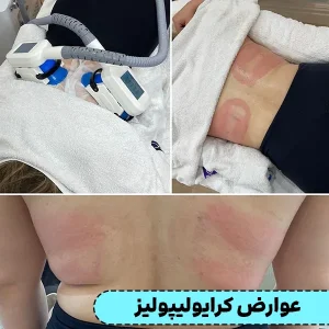 عوارض کرایولیپولیز