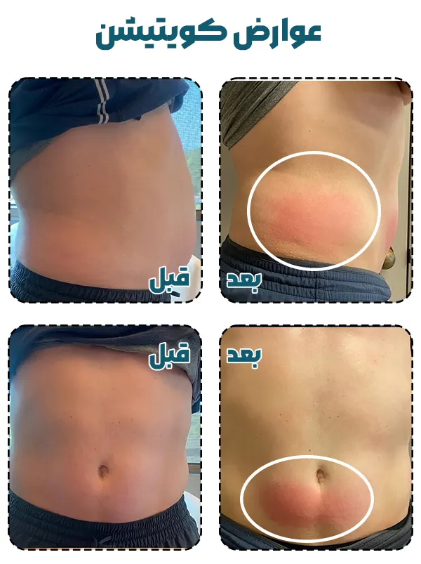 عوارض کویتیشن