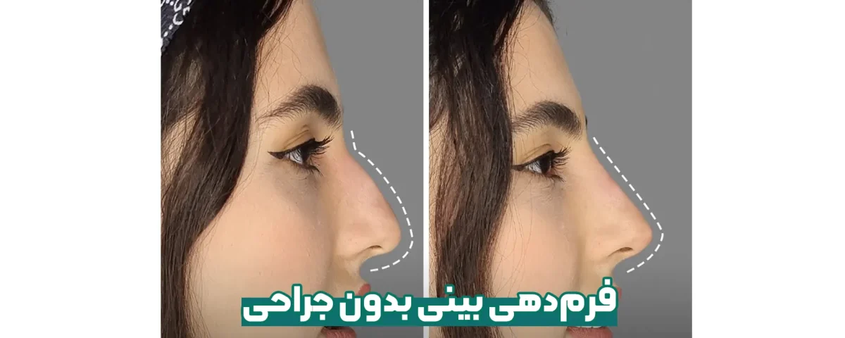 فرم دهی بینی بدون جراحی