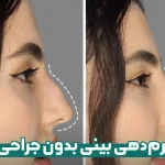 فرم دهی بینی بدون جراحی
