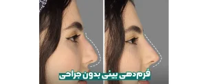 فرم دهی بینی بدون جراحی