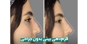 فرم‌دهی بینی بدون جراحی
