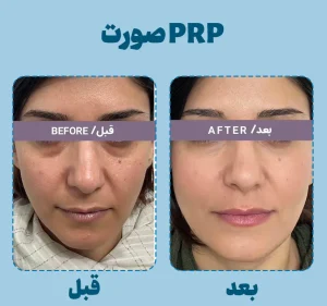 جوانسازی با prp