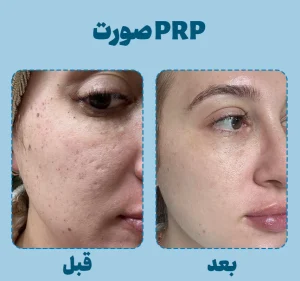 قبل و بعد prp