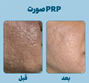قبل و بعد prp اسکار جوش