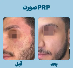prp صورت