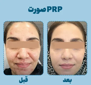 پی آر پی صورت