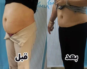 لاغری موضعی با دستگاه اگزیمیا