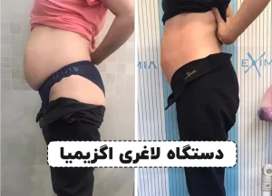 لاغری موضعی با دستگاه اگزیمیا
