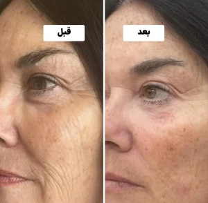 قبل و بعد جالپرو سوپر هیدرو