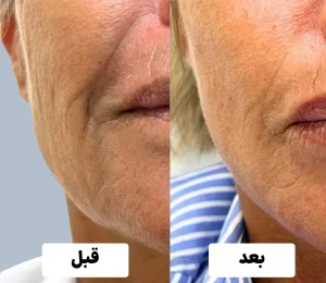 قبل و بعد جالپرو سوپر هیدرو