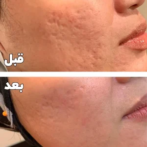 قبل و بعد جای جوش