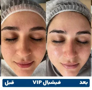 قبل و بعد فیشیال