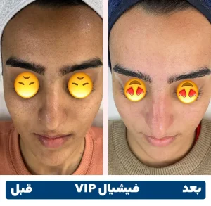 قبل و بعد فیشیال