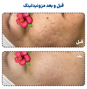 قبل و بعد مزونیدلینگ