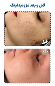 قبل و بعد مزونیدلینگ