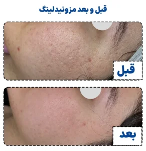 قبل و بعد مزونیدلینگ