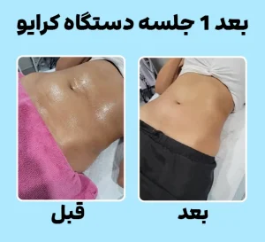 قبل و بعد کرایولیپولیز