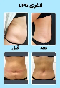 لاغری با دستگاه LPG