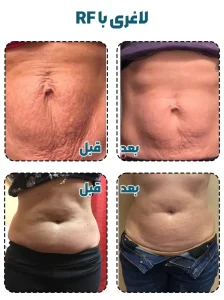لاغری با آر اف قبل بعد