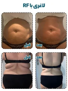 لاغری با آر اف قبل بعد