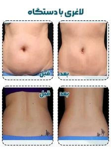 لاغری با دستگاه