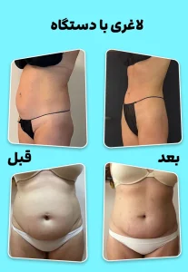 لاغری با دستگاه