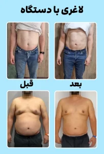 قبل و بعد لاغری با دستگاه