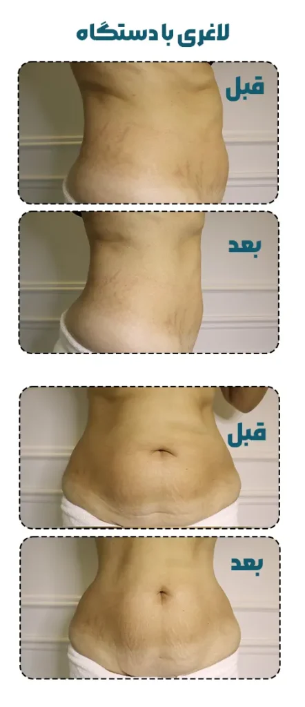 لاغری با دستگاه