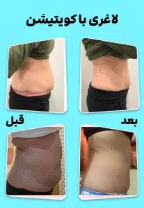 لاغری با کویتیشن