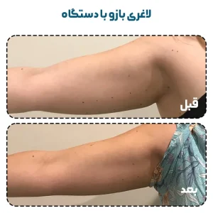 لاغری بازو با دستگاه