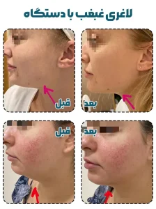 لاغری غبغب با دستگاه قبل و بعد