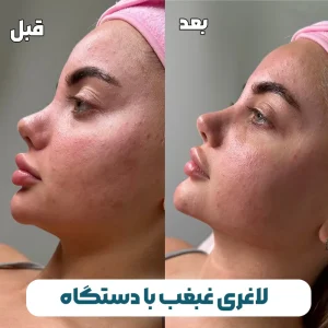 لاغری غبغب با دستگاه