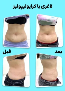 کرایولیپولیز قبل و بعد