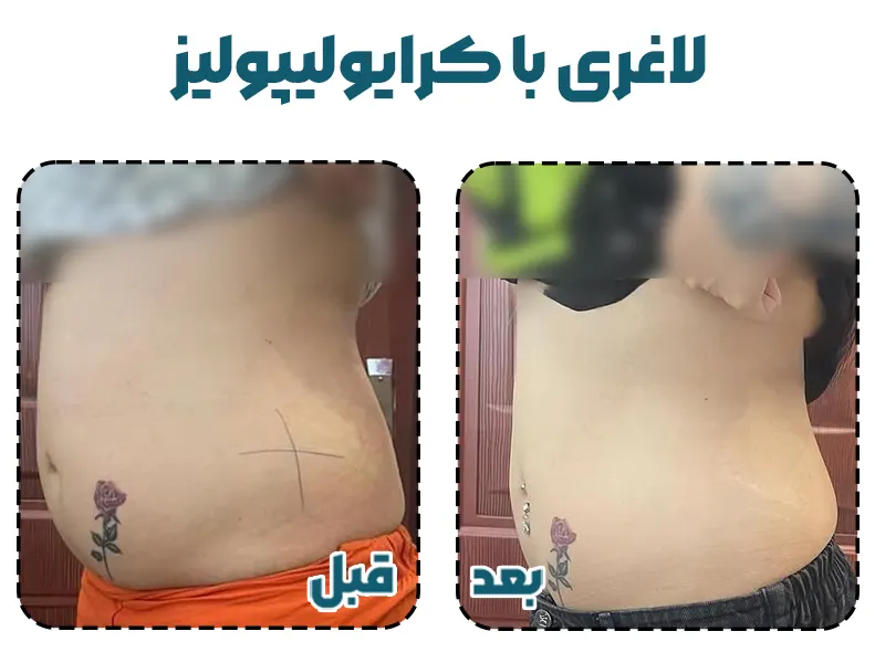 قبل و بعد لاغری با کرایولیپولیز