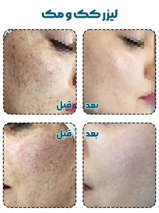 لیزر کک و مک