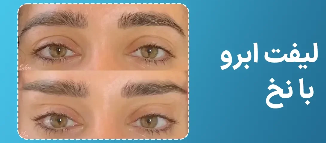 لیفت ابرو با نخ