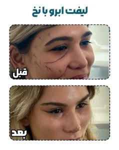 لیفت ابرو با نخ