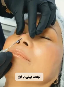 لیفت بینی با نخ