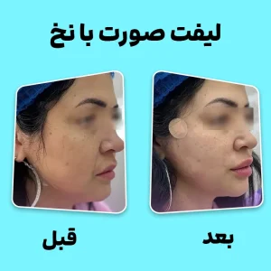 لیفت صورت با نخ