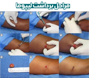 مراحل برداشت لیپوما