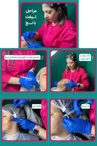 مراحل لیفت صورت با نخ