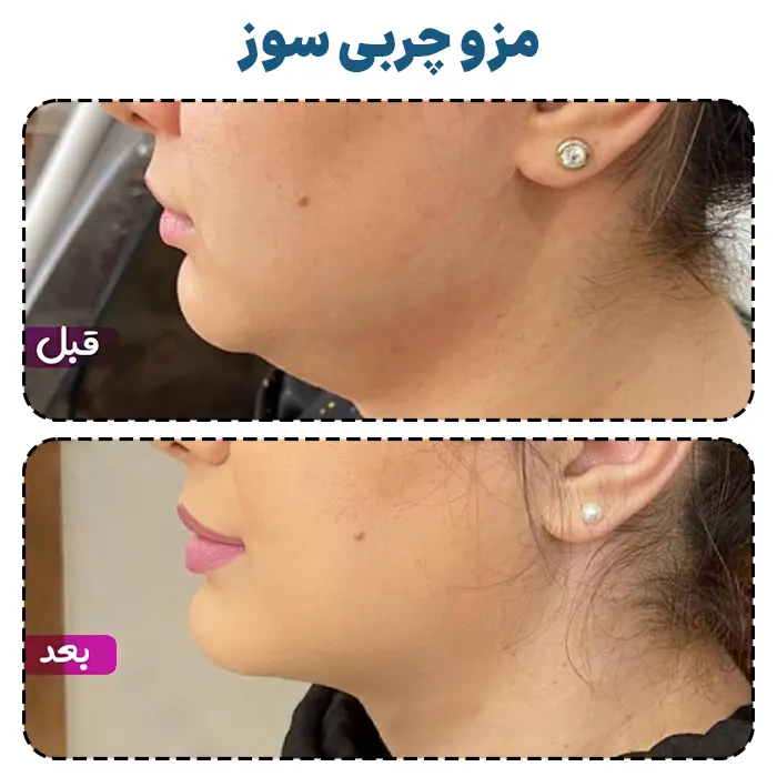مزو چربی سوز