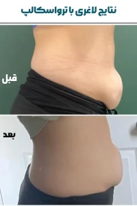 نتایج لاغری با ترواسکالپ