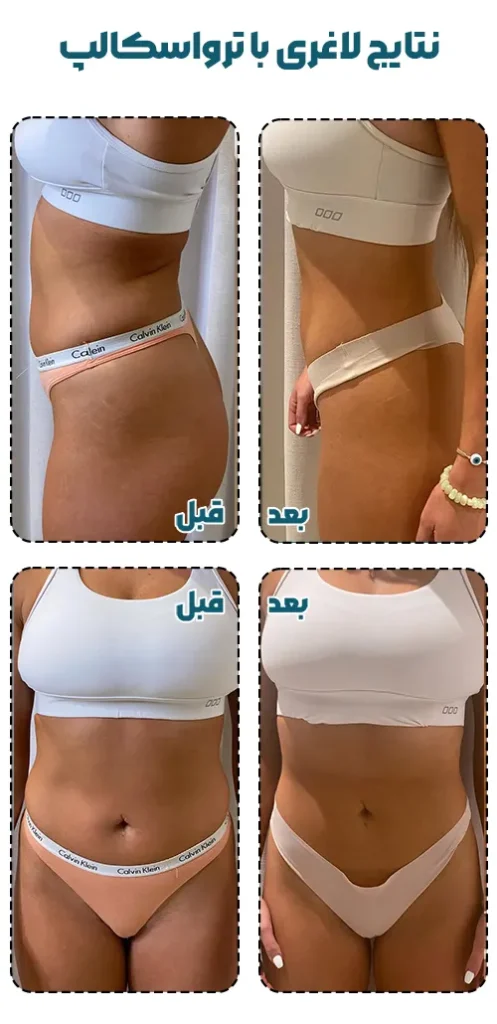 نتایج لاغری با ترواسکالپ